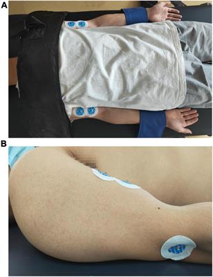 Surface electromyography analysis of mirror movements under unilateral movement in stroke patients: A retrospective study